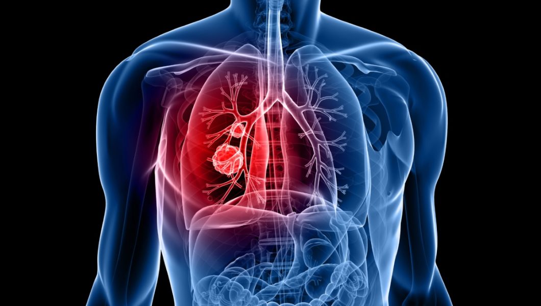 Antibioticele îmbunătățesc eficacitatea tratamentului pentru cancer