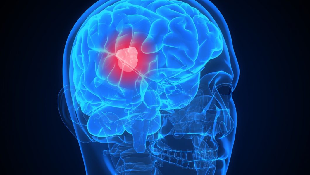Care sunt simptomele meningiomului