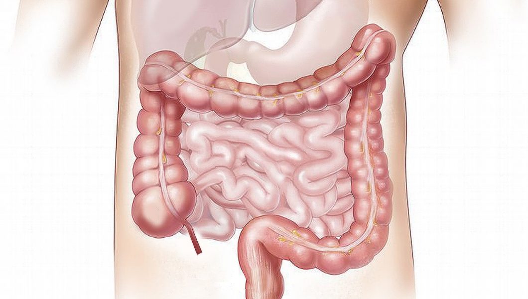 Factorii care pot declansa cancerul colorectal
