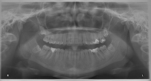 Cum prevenim situatiile care cer scoaterea nervului dentar