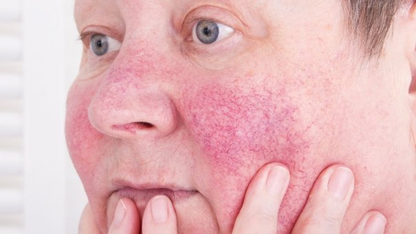 Cum putem trata cuperoza cu ajutorul sucurilor naturale