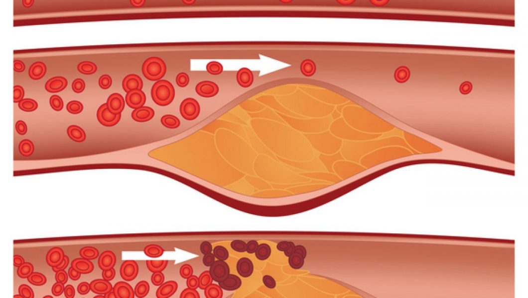 Dieta care infunda arterele din organism