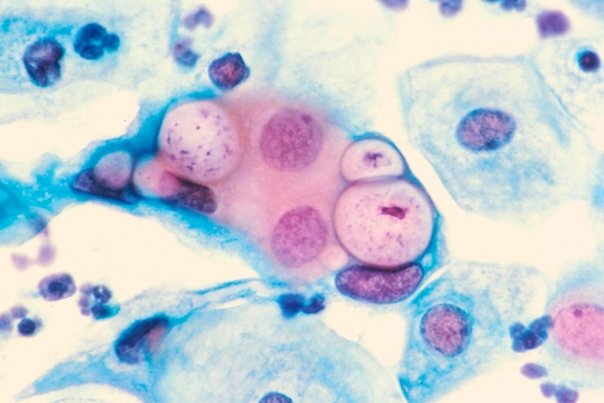 Este supranumita bacteria infertilitatii