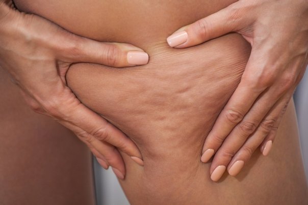 Remedii naturale interne pentru celuluita