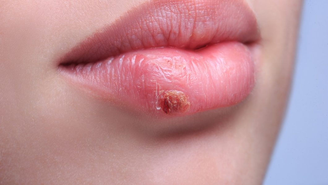 8 trucuri pentru a scăpa rapid de herpes