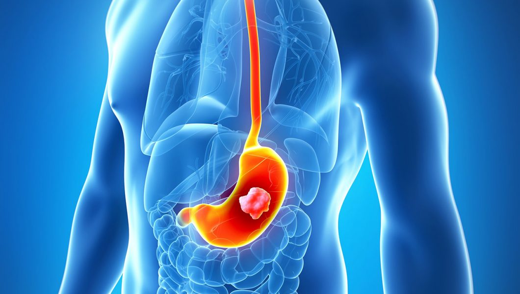 Activitatea fizica regulata reduce riscul de aparitie al mai multor tipuri de cancer