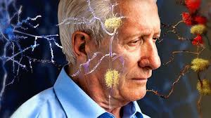 Testul care poate depista anticipat boala Alzheimer