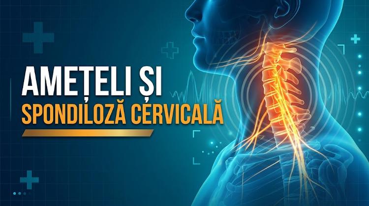 Amețeli și spondiloză cervicală - ilustrație medicală a coloanei vertebrale