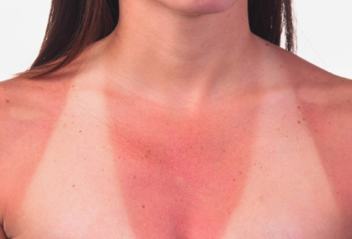 Remedii pentru arsuri solare