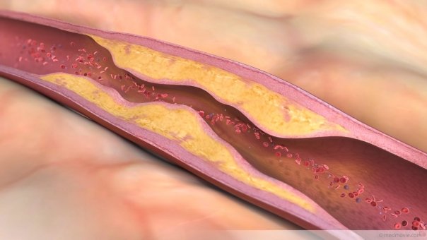 Simtomatologia in cazul arterelor infundate