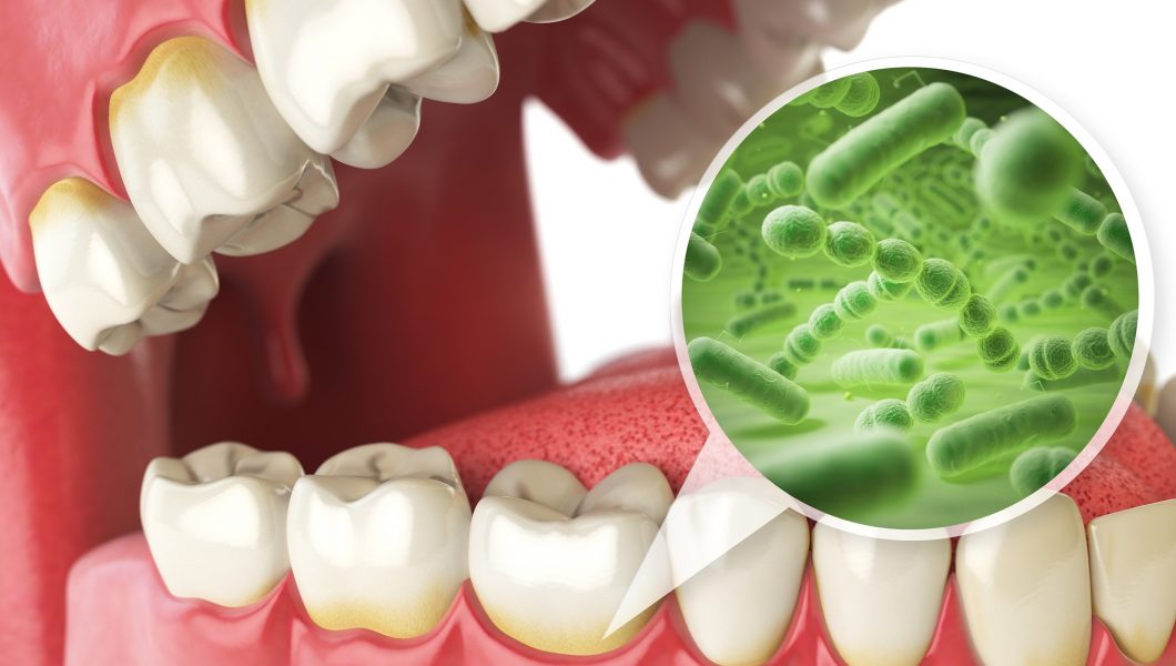 Descopera ce bacterie din gura iti poate distruge creierul