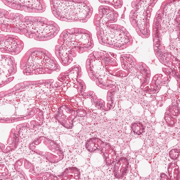Infectia bacteriana care ataca intreg organismul