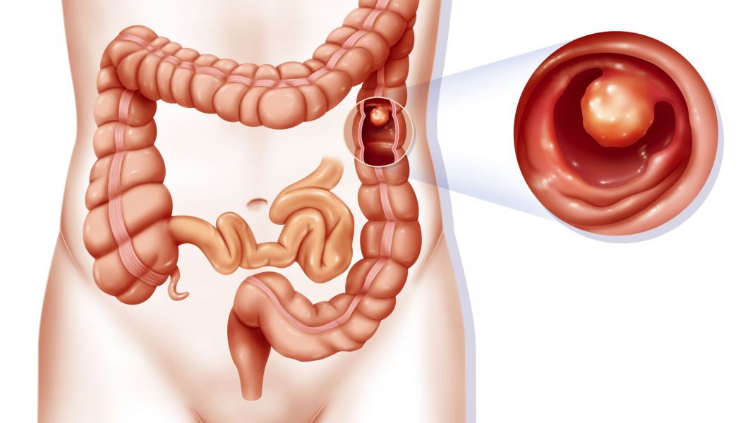 Polipii de colon, sursa de cancer. Cat de des trebuie facuta colonoscopia