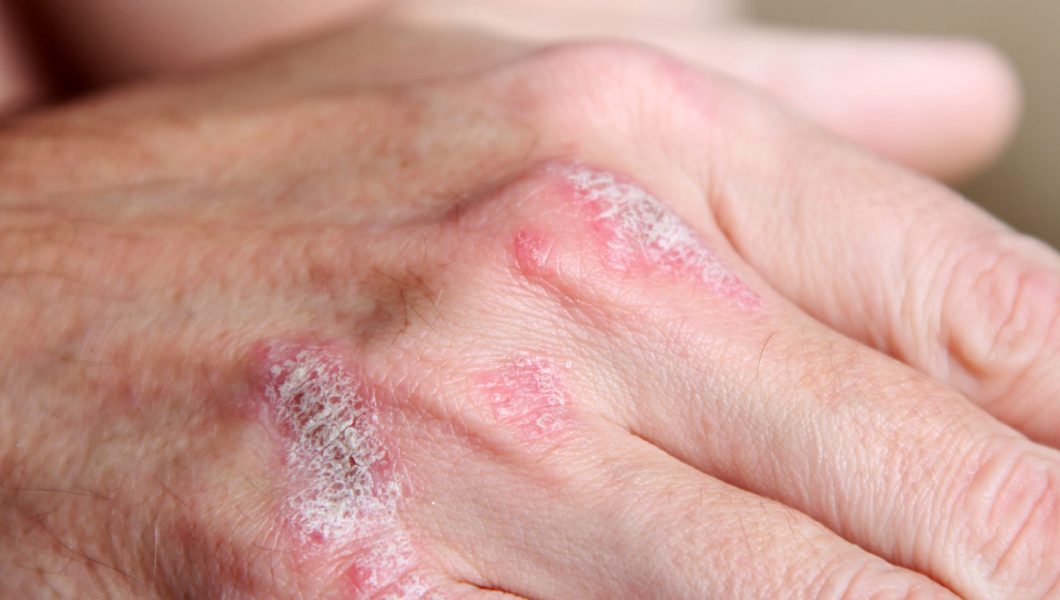 Cum trebuie sa tratam corect psoriazisul