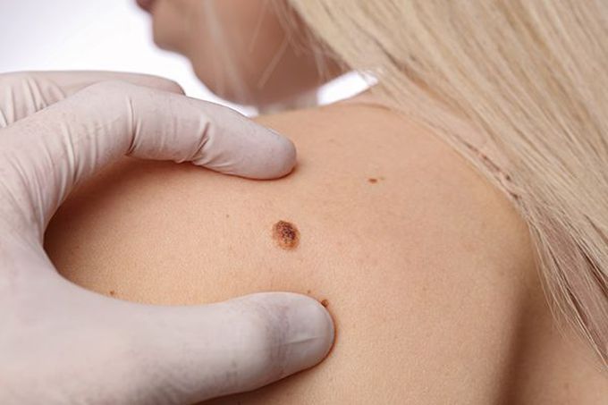 Ce poate detecta dermatoscopia analizând aluniţele