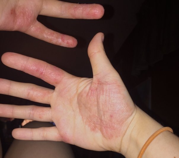tratament eczema