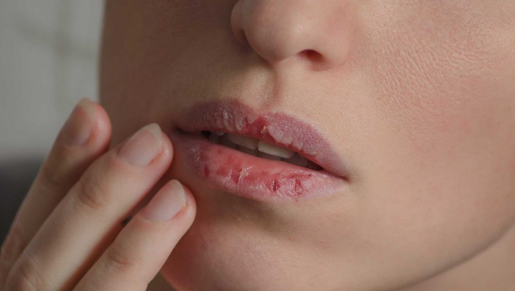 Deficienta de fier apare atunci cand mineralul lipseste din dieta sau nu este asimilat, din cauza pierderilor de sange sau a sarcinii. Lasata netratata, deficienta de fier poate duce la complicatii grave. Este important sa stim sa recunoastem semnele si simptomele pentru a evita complicatiile