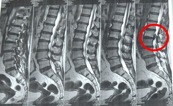 Terapia care ne poate scapa de operatia de hernie de disc