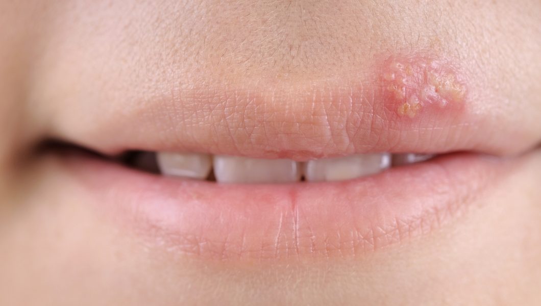 Virusul herpes simplex. Cercetatorii au descoperit cum poate virusul sa se reactiveze