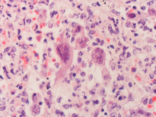 herpes simplex