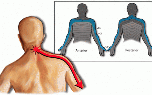 Sindromul cervico-brahial