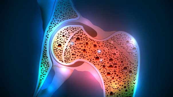 osteoporoza