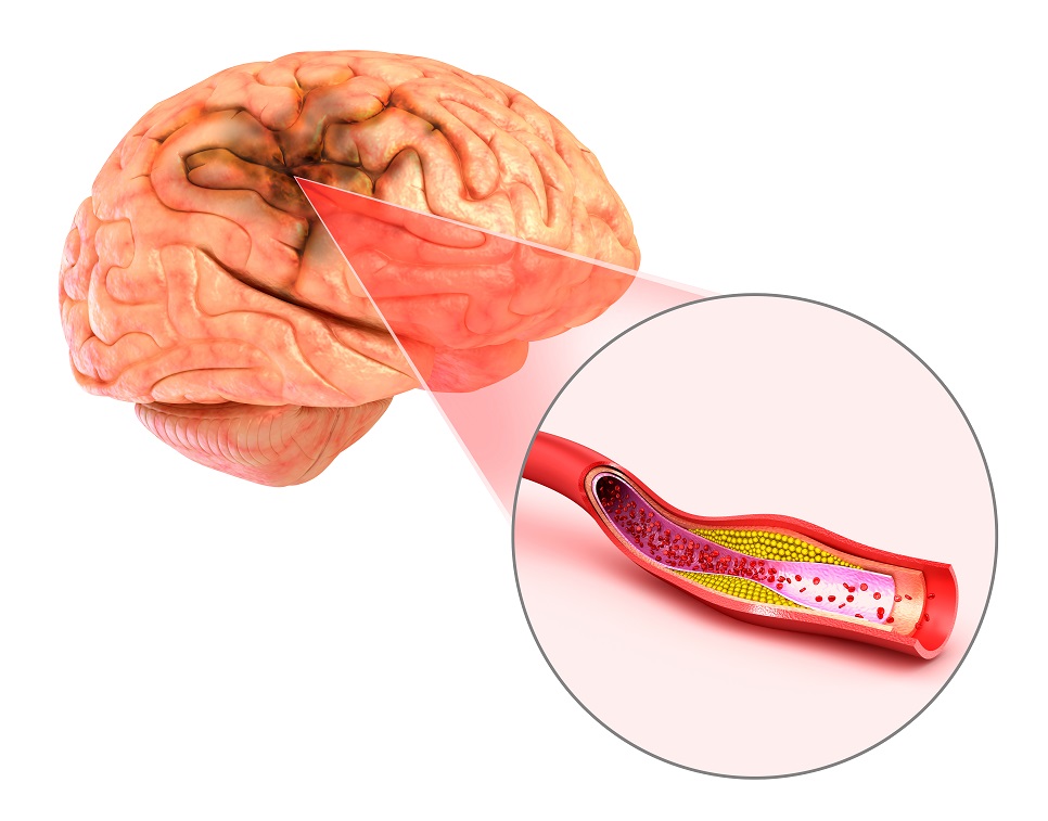Cum recunoastem accidentul vascular cerebral