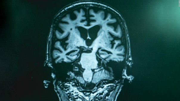 S-a mai descoperit o cauza a Alzheimerului