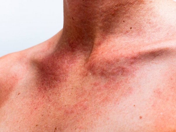 Cum recunoastem si cum tratam alergia la caldura