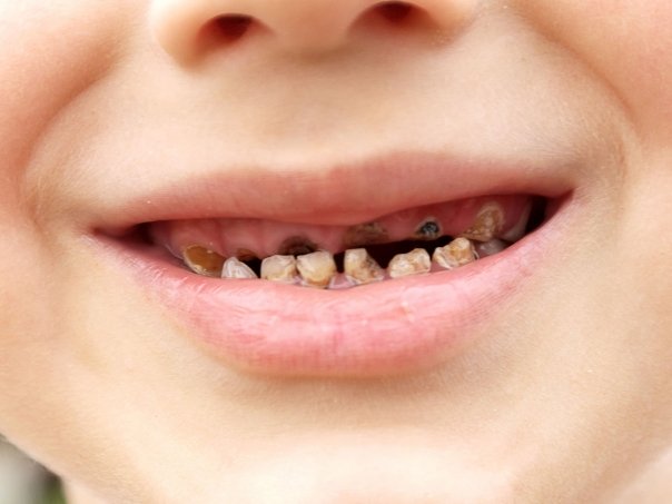 Cum prevenim cariile copiilor