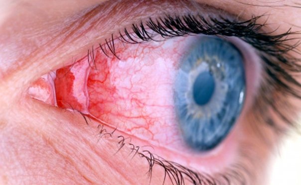 Afectiunea extrem de contagioasa, tot mai prezenta in acest sezon