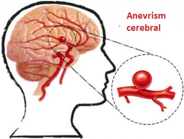 Analiza care depisteaza anevrismul, indiferent in ce parte a aortei se situeaza