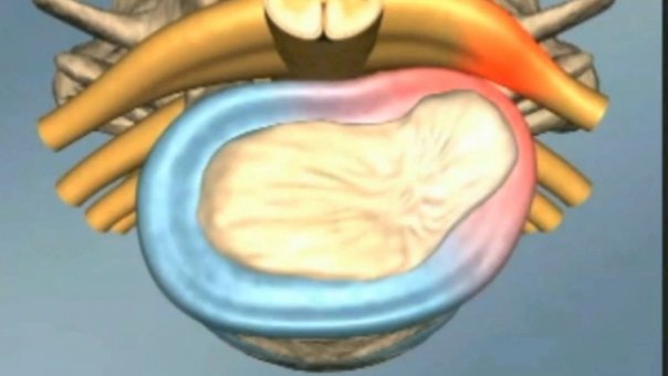 Cel mai rapid remediu pentru hernia de disc