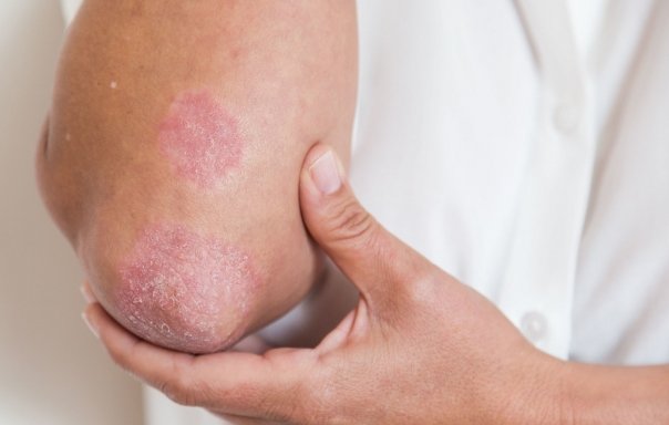 Dieta care reduce simptomele psoriazisului