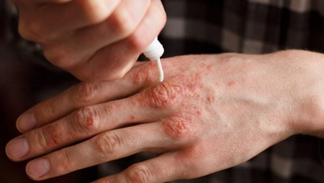 Cum se poate trata psoriazisul in mod natural