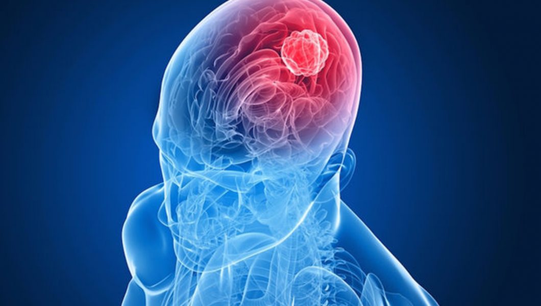 Utilizarea excesiva a telefonului mobil provoaca cancer cerebral